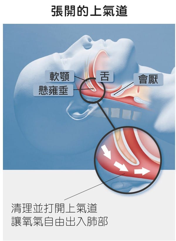 張開的上氣道