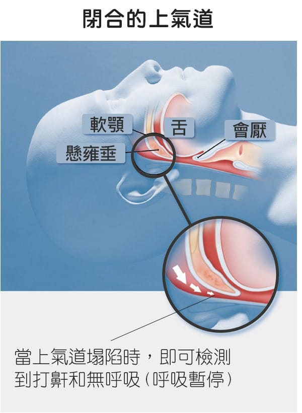 閉合的上氣道