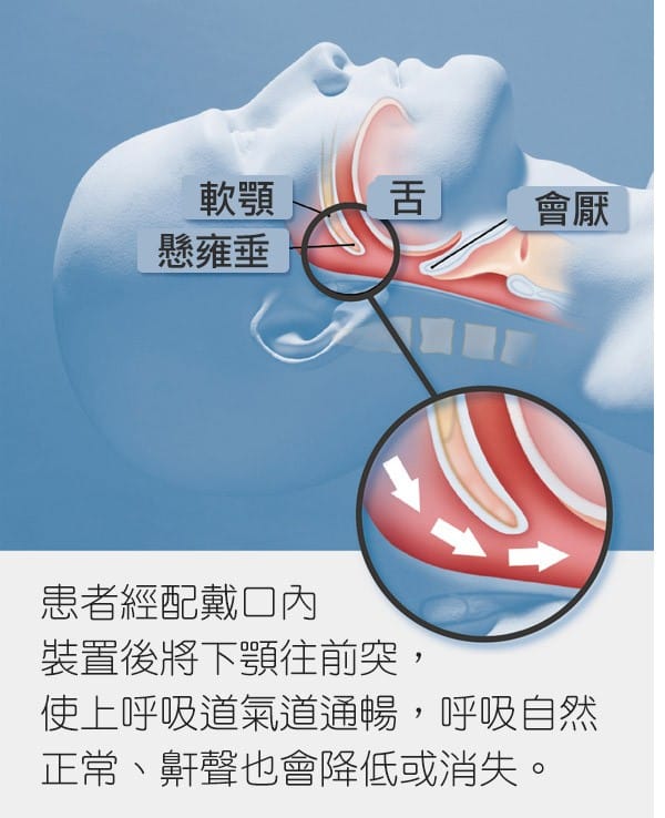 睡眠止鼾實作方式